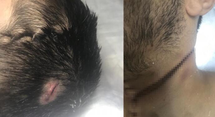 Sıddık Uğur’un vücudunda işkence izleri