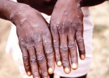 4 ülkede daha maymun çiçeği virüsü tespit edildi