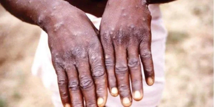 4 ülkede daha maymun çiçeği virüsü tespit edildi