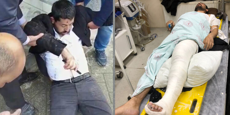Ayağı kırılan HDP Milletvekili Eksik ameliyat oldu
