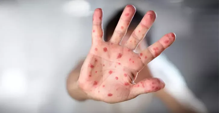 Sağlık Bakanlığı kızamık vaka artışlarını kabul etti