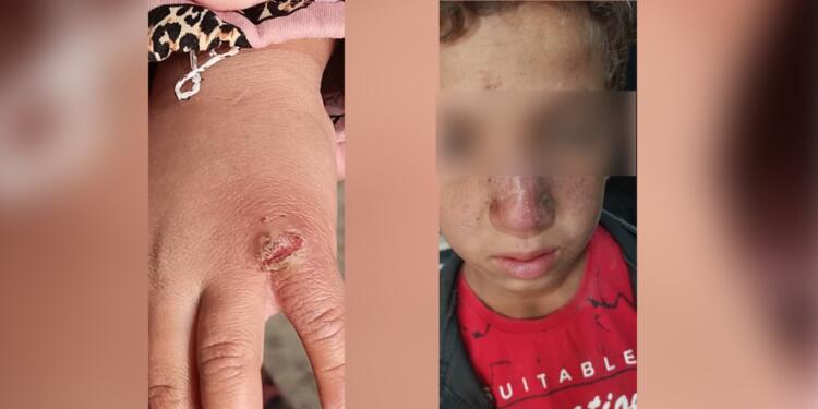 Minbic’te Leishmania hastalığı yayılıyor