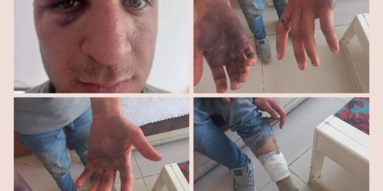 Gözaltında işkenceye ‘düşerken oldu’ kılıfı!