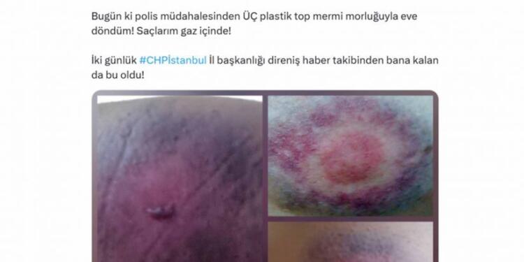 Gazeteci Fatoş Erdoğan Polis saldırısında yaralandı